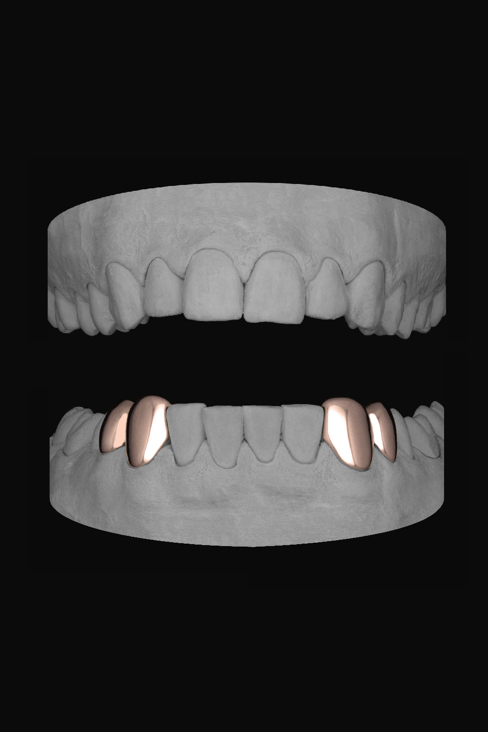 2 x Canine & premolar (Lower)
