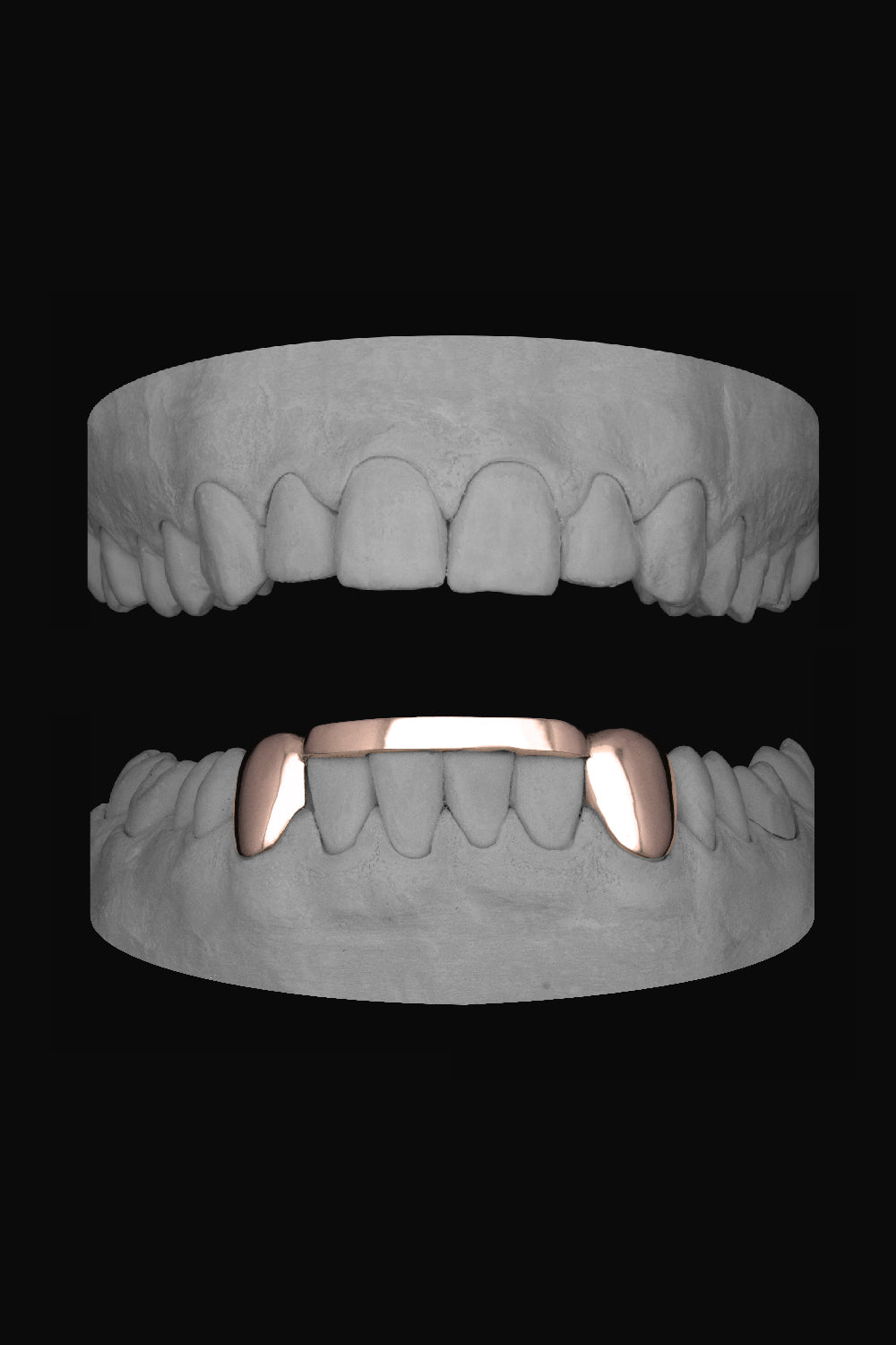 2 x Canines with Bar