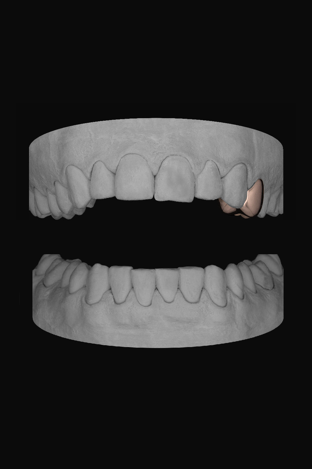Premolar