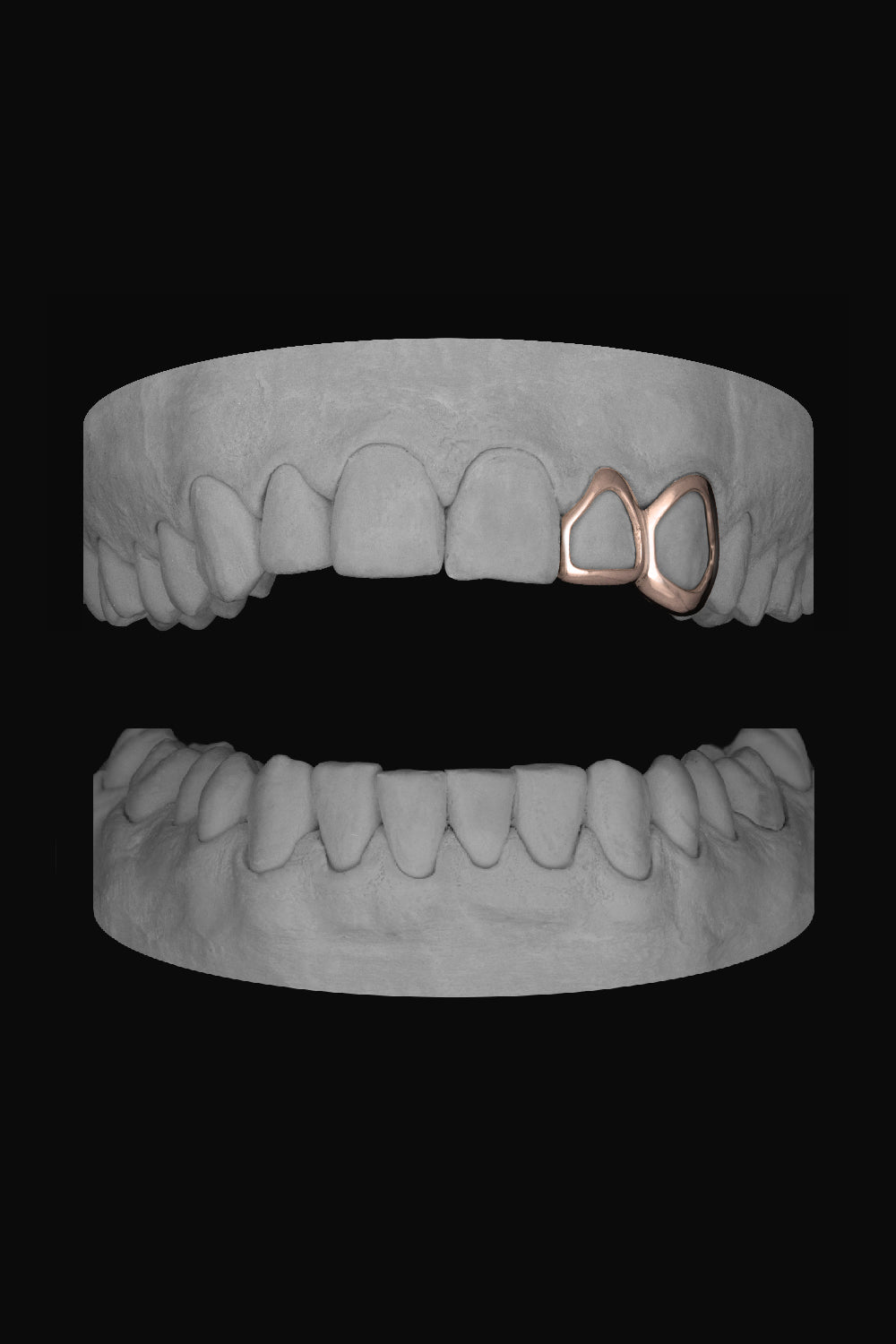 Window Lateral & Window Canine