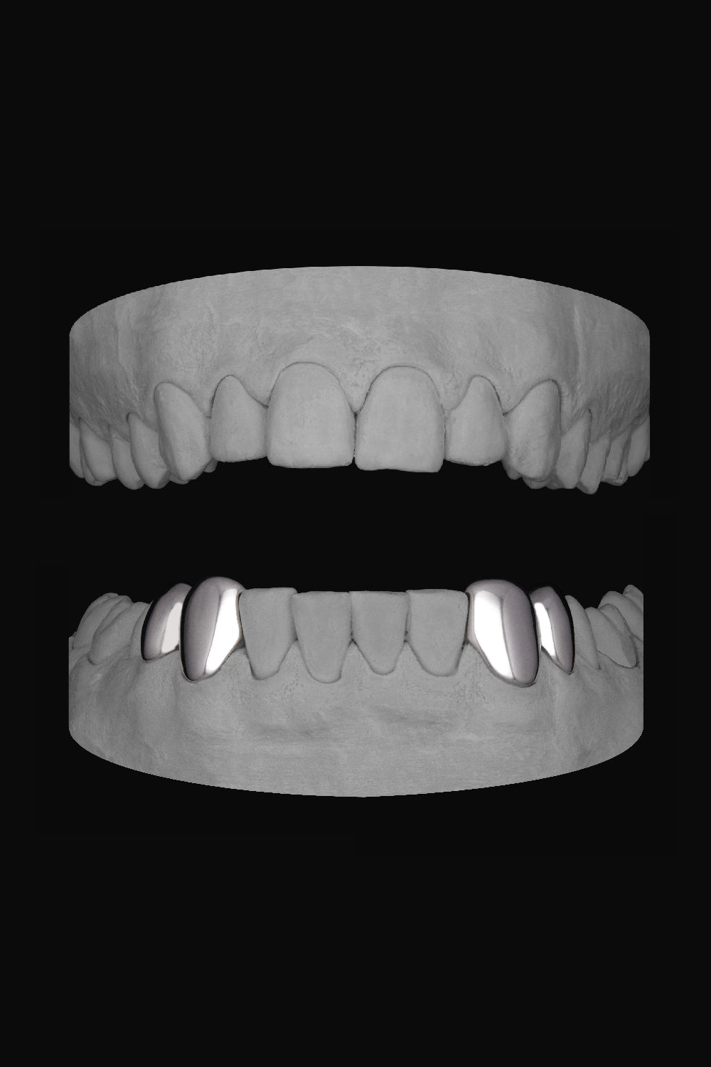 2 x Canine & premolar (Lower)