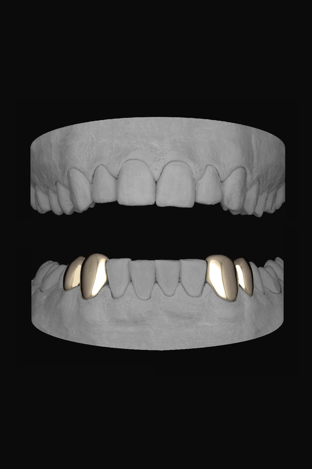 2 x Canine & premolar (Lower)