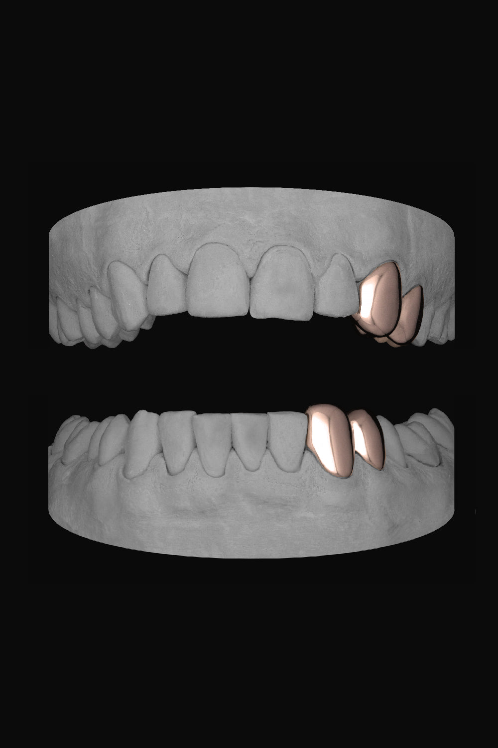 2 x Canine & Premolar (Upper & Lower)